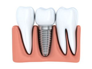 Dental Implant